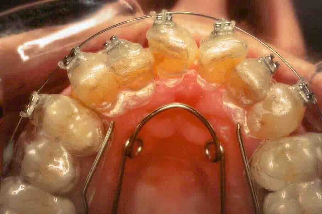 3 Hybrid Aligners Pre Invisalign