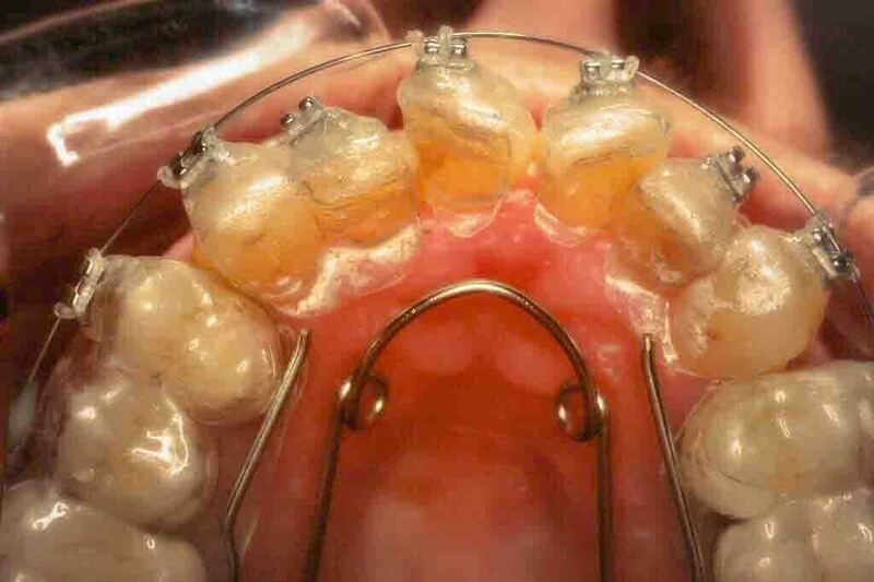 3 Hybrid Aligners Pre Invisalign