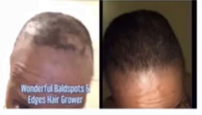 Wonderful Bald Spot &amp; Edges Hair Grower