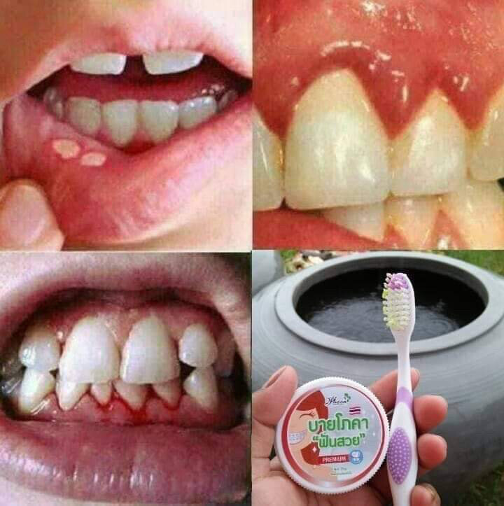ថ្នាំដុសធ្មេញបាយផូខា  (By Phoca toothpaste )