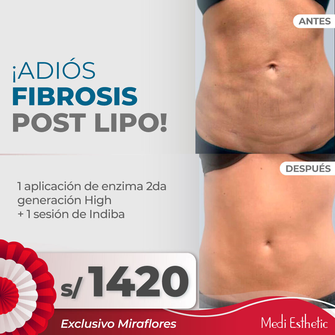 Fibrosis Post Lipo