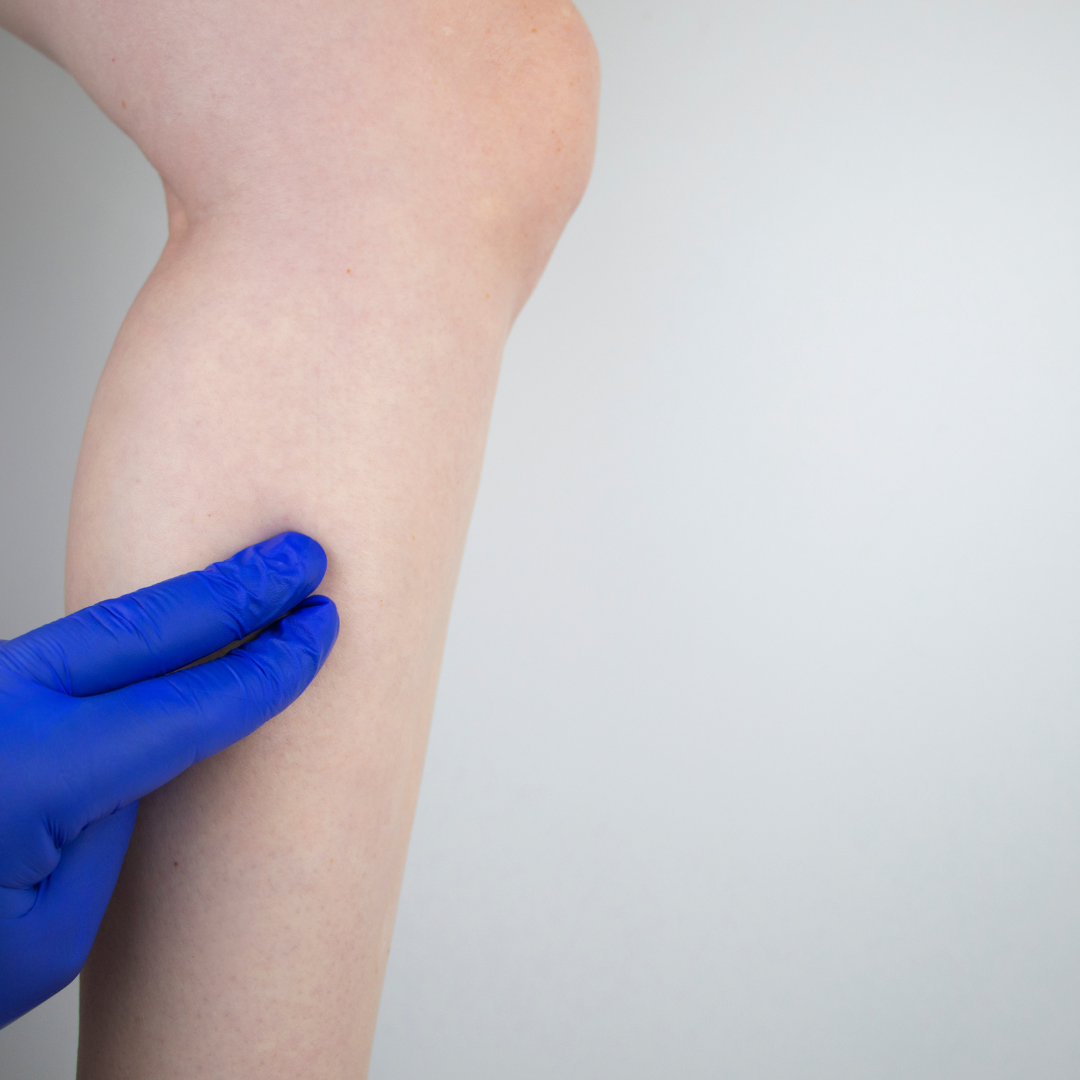 Terapia de rehabilitación de las pantorrillas (gastrocnemio)