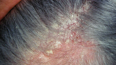 Scalp Problems