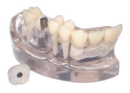 PREMIUM PLUS, (IMPLANT-001) SINGLE MOLAR IMPLANT MODEL