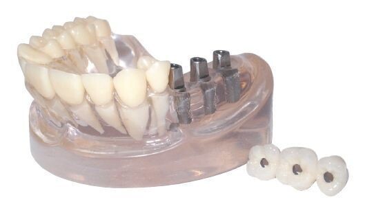 PREMIUM PLUS, (IMPLANT-003) 3 UNIT BRIDGE POSTERIOR