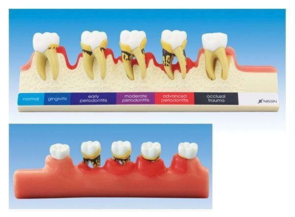 PREMIUM PLUS, (PE-PER010) PERIODONTAL DISEASE MODEL (MOVABLE TEETH)