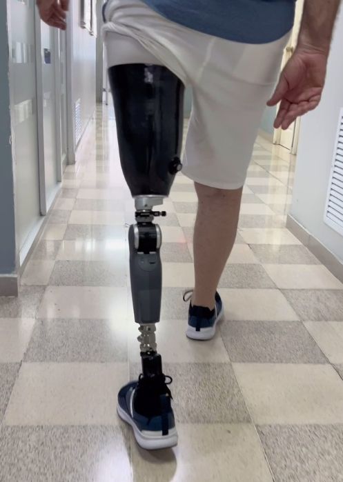 Consulta para confección de Prótesis robótica y/o mecánica de Miembro Inferior