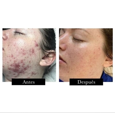 Dermalux Flex