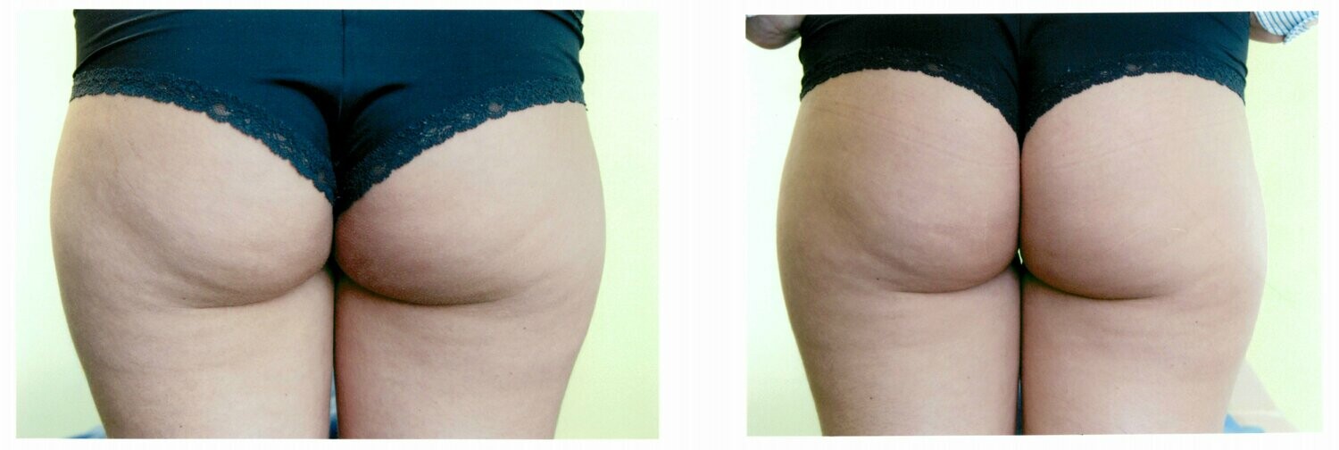 Carboxy  - Body/Face