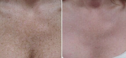 IPL - Chest