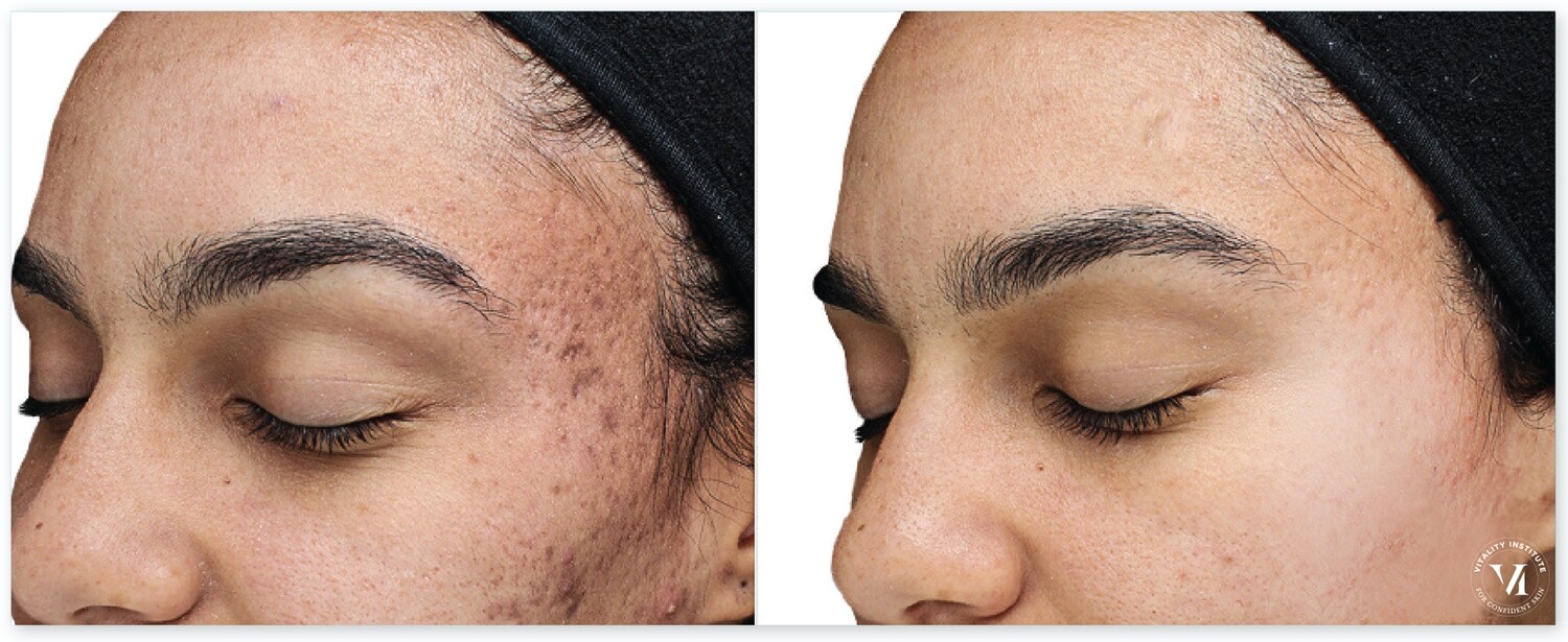 Chemical Peel - ViPeel - Purify
