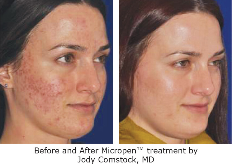 SKINPEN Micropen - Face
