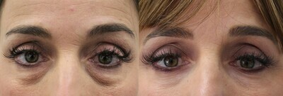 CO2 (Eyes or Neck or Chest)