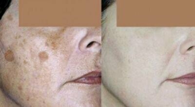 IPL - Full Face (3 Sessions)