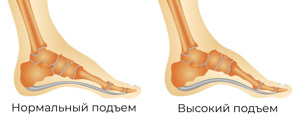 Высокий Подъем У Ребенка Фото