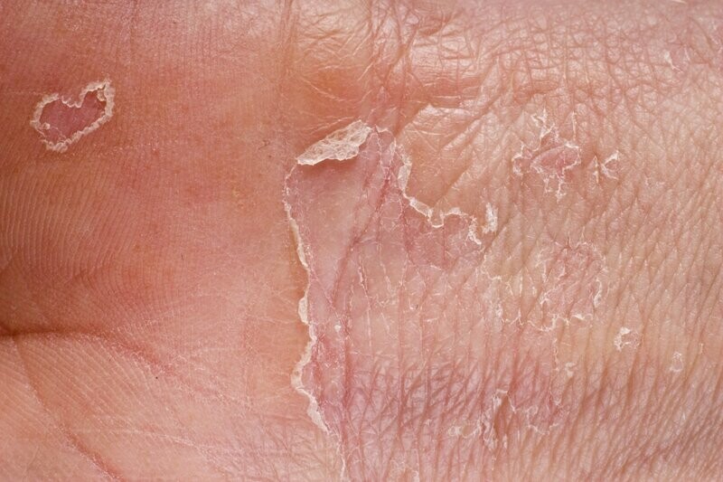 Zelltransformation  HAUTKRANKHEITEN