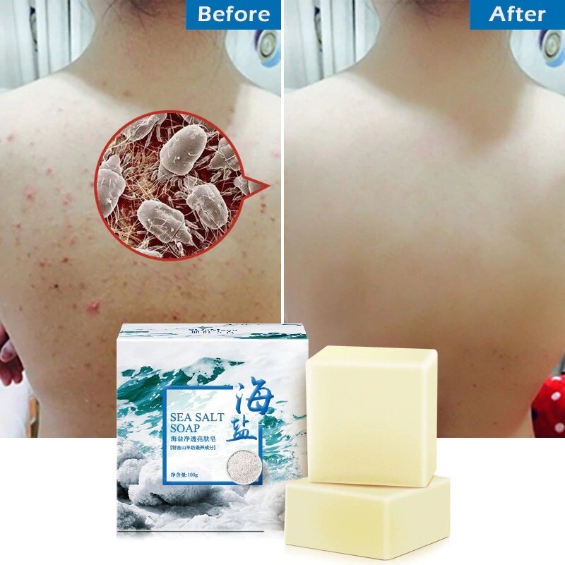 100g Removal Pimple Pore Acne Treatment