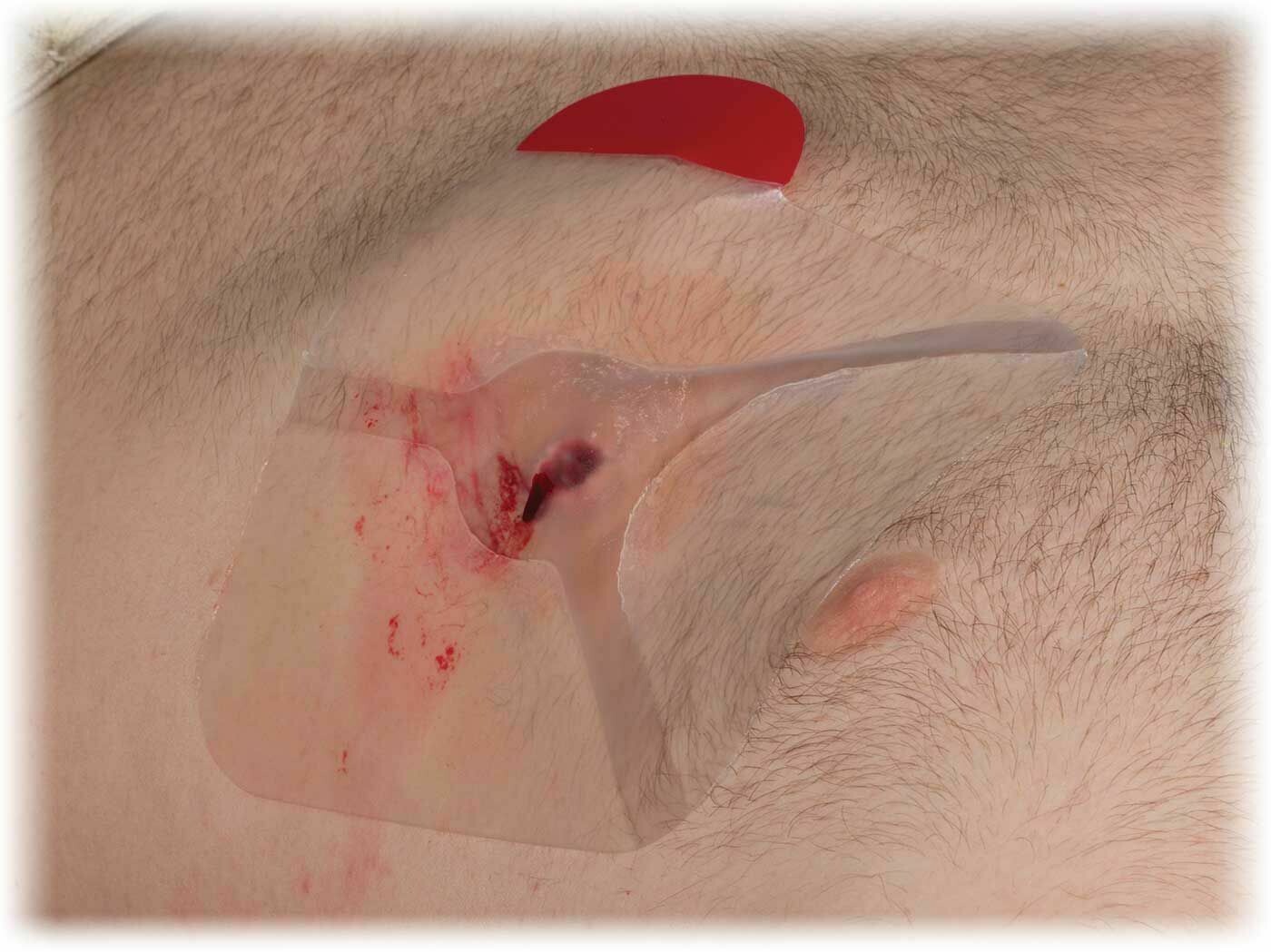 HyFin Vent Chest Seal Twin Pack