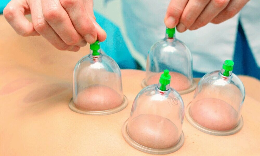 Terapia con ventosas- cupping