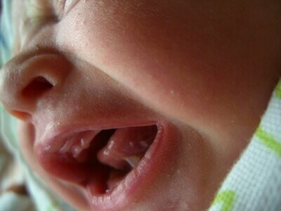 Frenotomie des Frenulum linguae beim Säugling mit Ankyloglossie - Einzel PDF