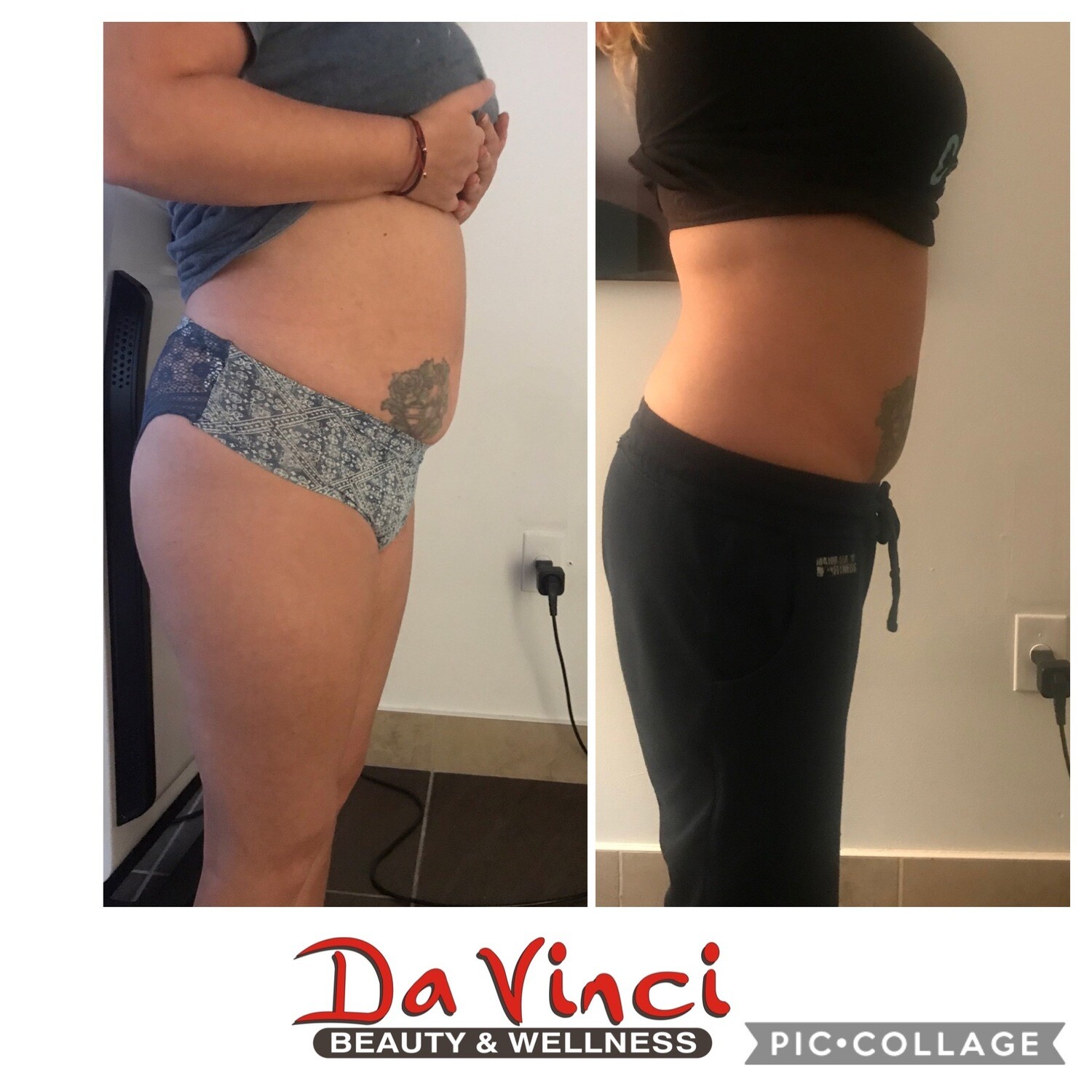 One cellulite reduction with Radio Frequency and vacuum massage session