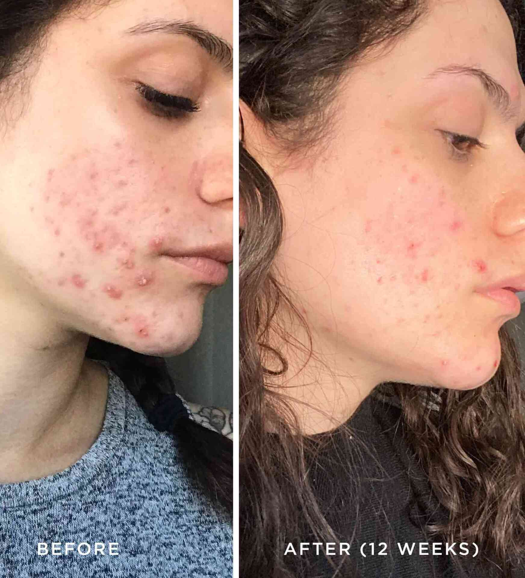 Violet Ear Electrode