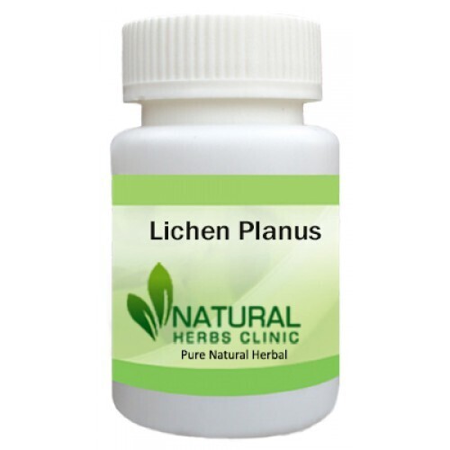 Herbal Product for Lichen Planus