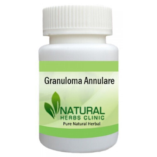 Herbal Product for Granuloma Annulare