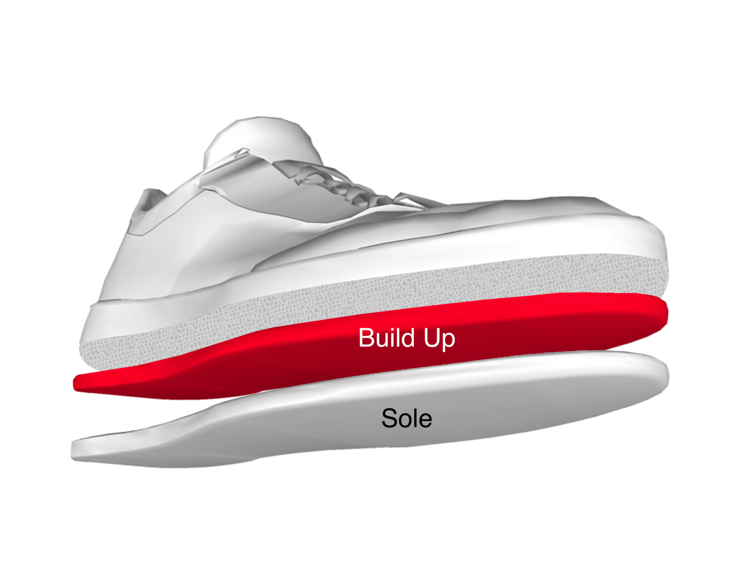 Orthopedic Build Ups, Build Up Type: Sandwich / Embedded (most common)