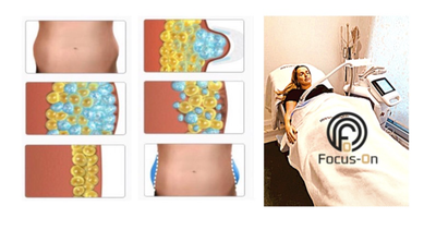 Actie Cryolipolise 3X + 20X EMS training