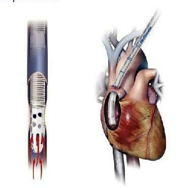 MC2X™ Three Stage Venous Cannulae
