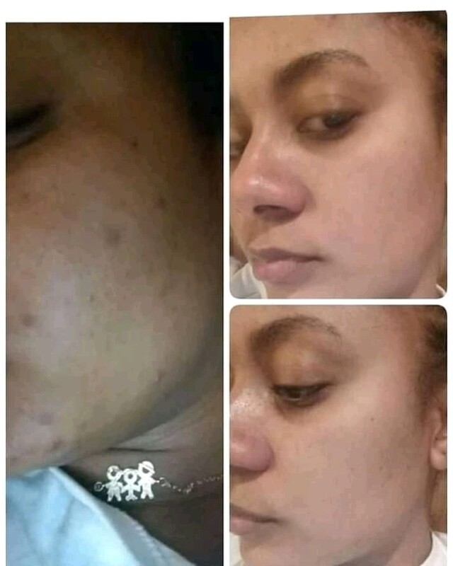 Limpieza Facial Profunda ultrasónica+microdermabrasion y A.L.F