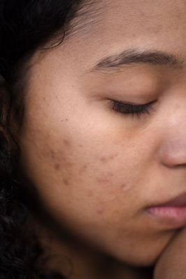 Onzuivere/acne huid