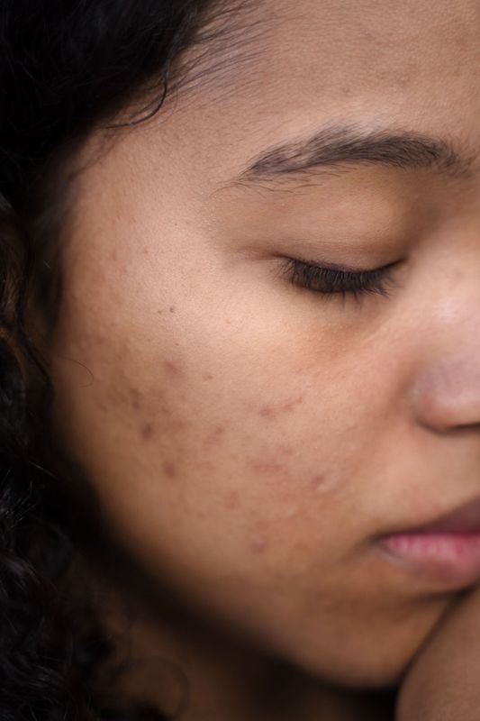 Onzuivere/acne huid