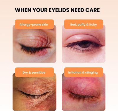 Blephaderm® – Soothing Eye & Eyelid Cream (40ml)