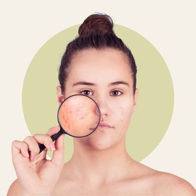 Acne / Gemengde huid