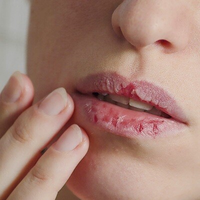 Droge en gesprongen lippen