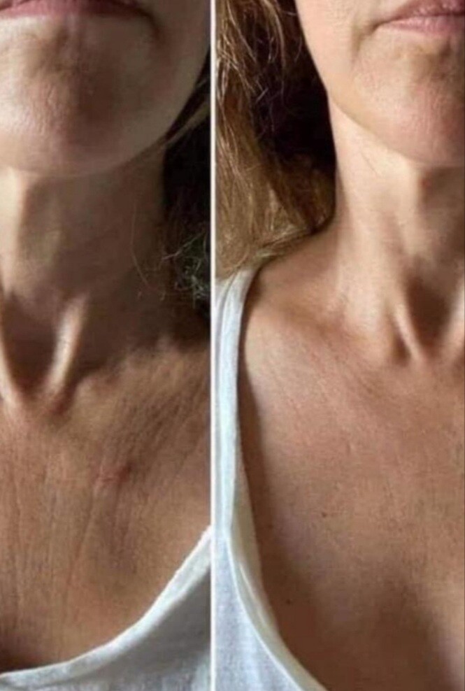 NU SKIN ageLOC Dermatic Results