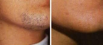 Epilation laser Lèvre + menton. Promo 6 séances PROMO 25 ans