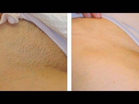 Epilation Définitive Bikini échancré Promo 4 +1 gratuite