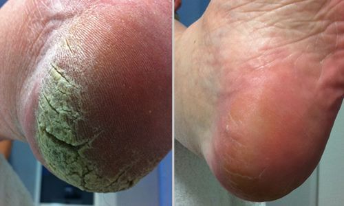 PEDICURE CON CALLUS