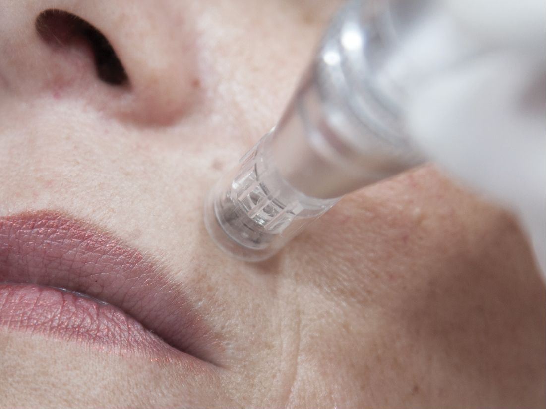 TRATTAMENTO MICRONEEDLING CONTORNO LABBRA