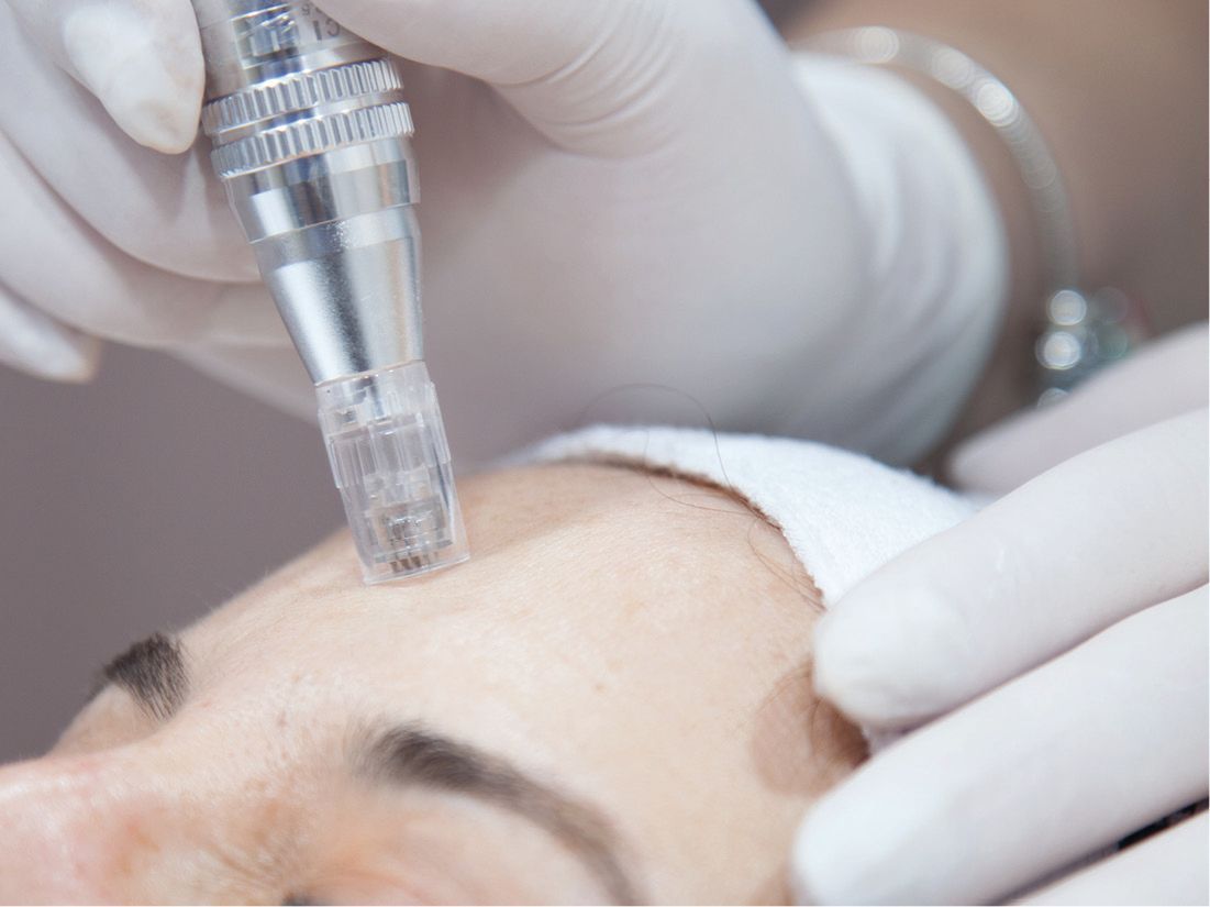 TRATTAMENTO MICRONEEDLIG VISO