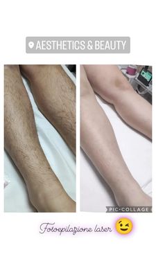 EPILAZIONE LASER
