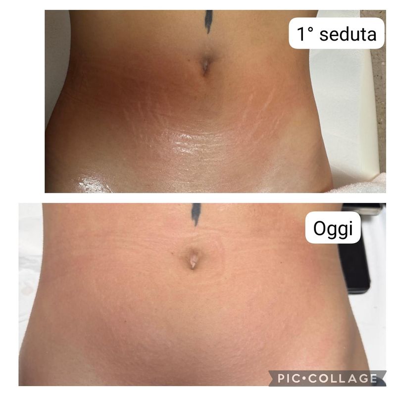 TRATTAMENTO MICRONEEDLING SMAGLIATURE TRATTAMENTO MICRONEEDLING SMAGLIATURE