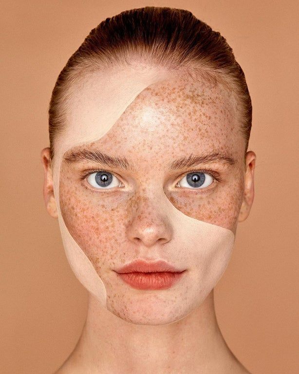 Pigmentation Management