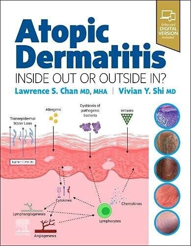 Atopic Dermatitis