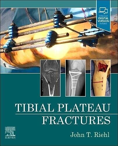 TIBIAL PLATEAU FRACTURES