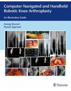 Computer Navigated and Handheld Robotic Knee Arthroplasty: An Illustrative Guide