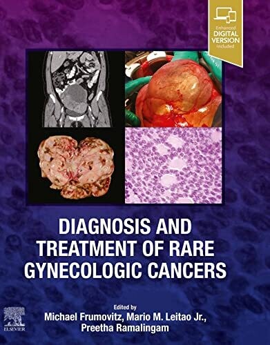 Diagnosis and Treatment of Rare Gynecologic Cancers